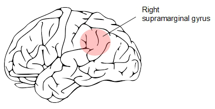 r sup marginal gyrus